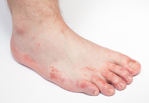 Fungal Foot Infections | Werkman, Boven 