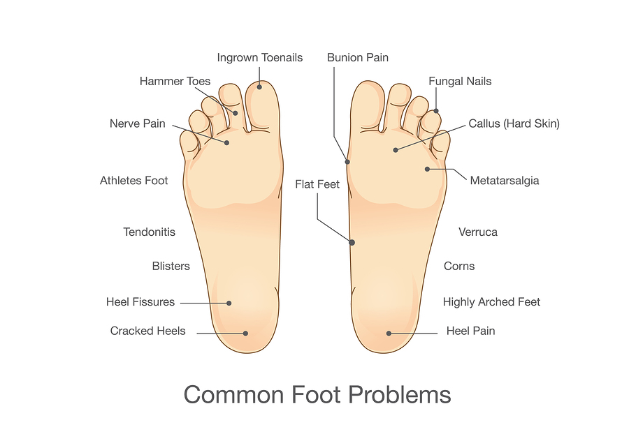 Bottom Foot Pain Chart