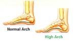 The Skinny on High Arches (Pes cavus) - Werkman, Boven & Associates