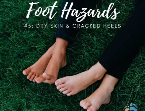 Summer Foot Hazards # 5: Dry Skin & Cracked heels