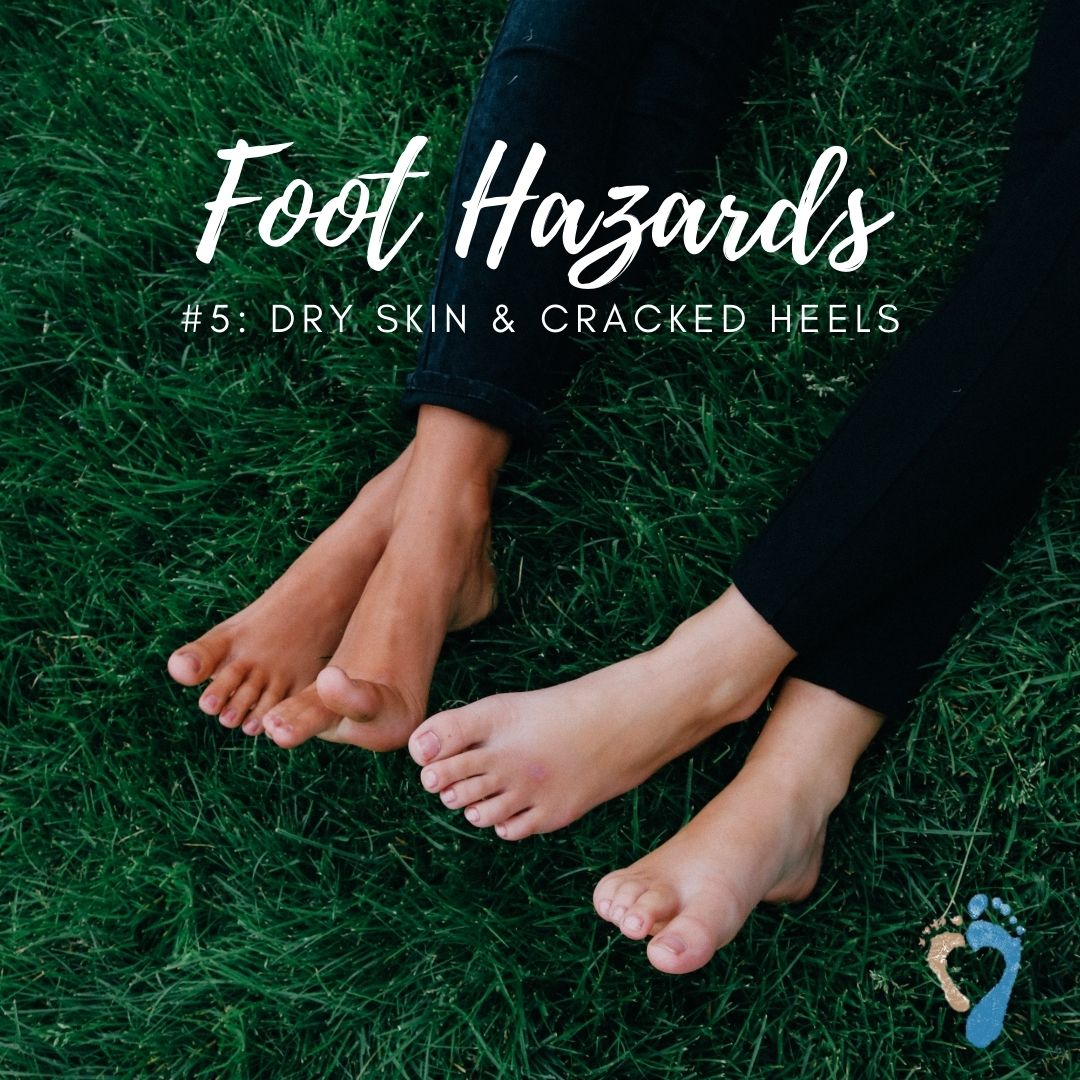 How Can I Treat Cracked Heels? – My FootDr