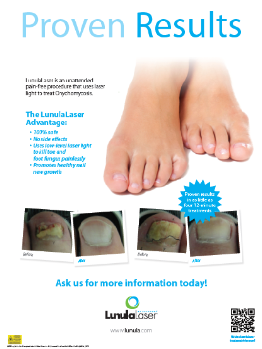 LunulaLaser® Treatment for Fungal Nails - Oakville ON