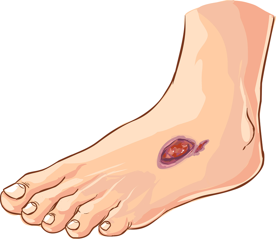 causes-foot-ulcer-wound