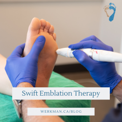 swift emblation therapy