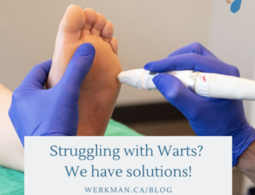 Struggling with Warts? We have solutions!