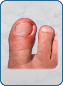 ingrown toenails