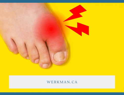 What You Need to Know About Gout