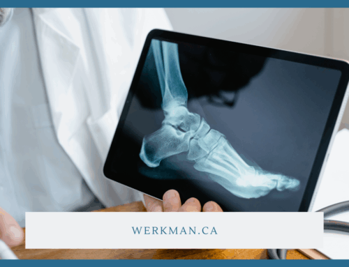 Understanding Heel Spurs