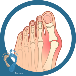 bunion skeleton toe