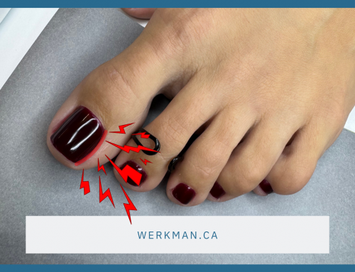 Painful Ingrown Toenails? Here’s the Treatment
